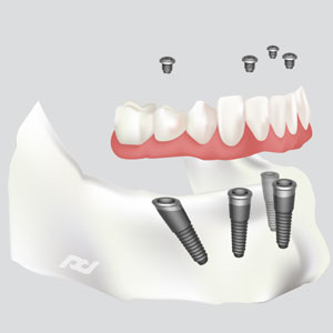 All-on-4 Dental Implants in Berkeley, CA